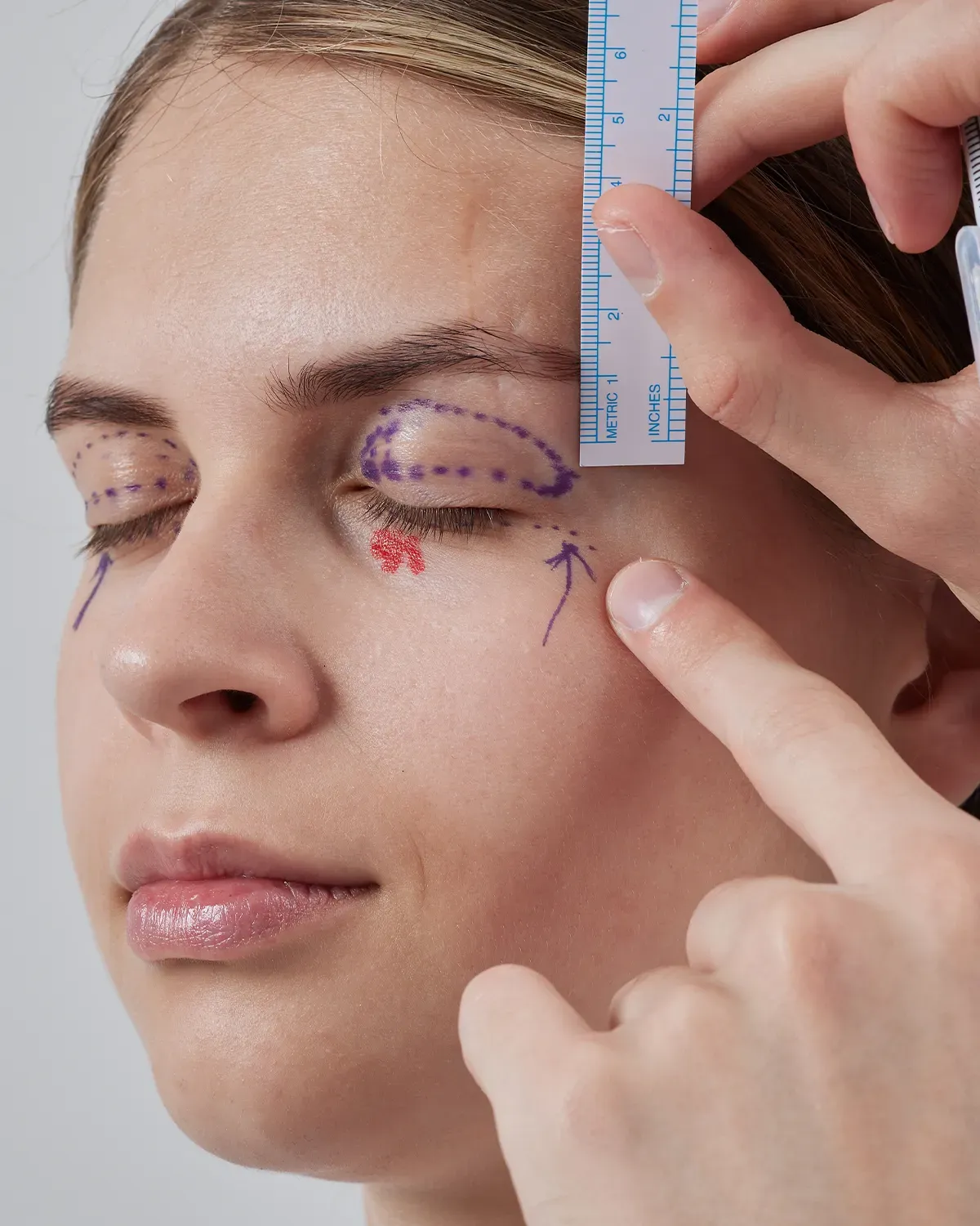 Blefaroplastia