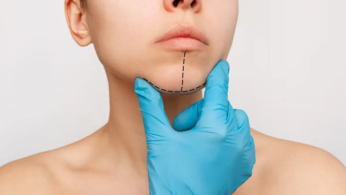 Mentoplastia