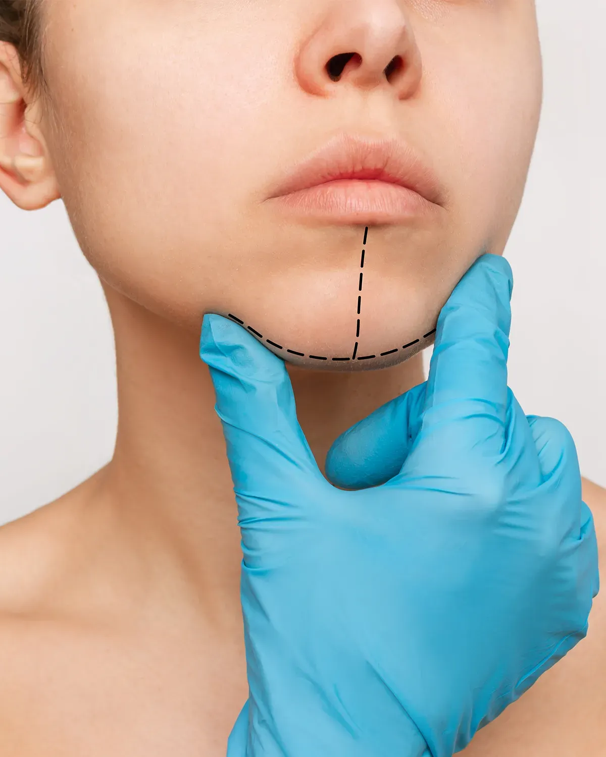 Mentoplastia