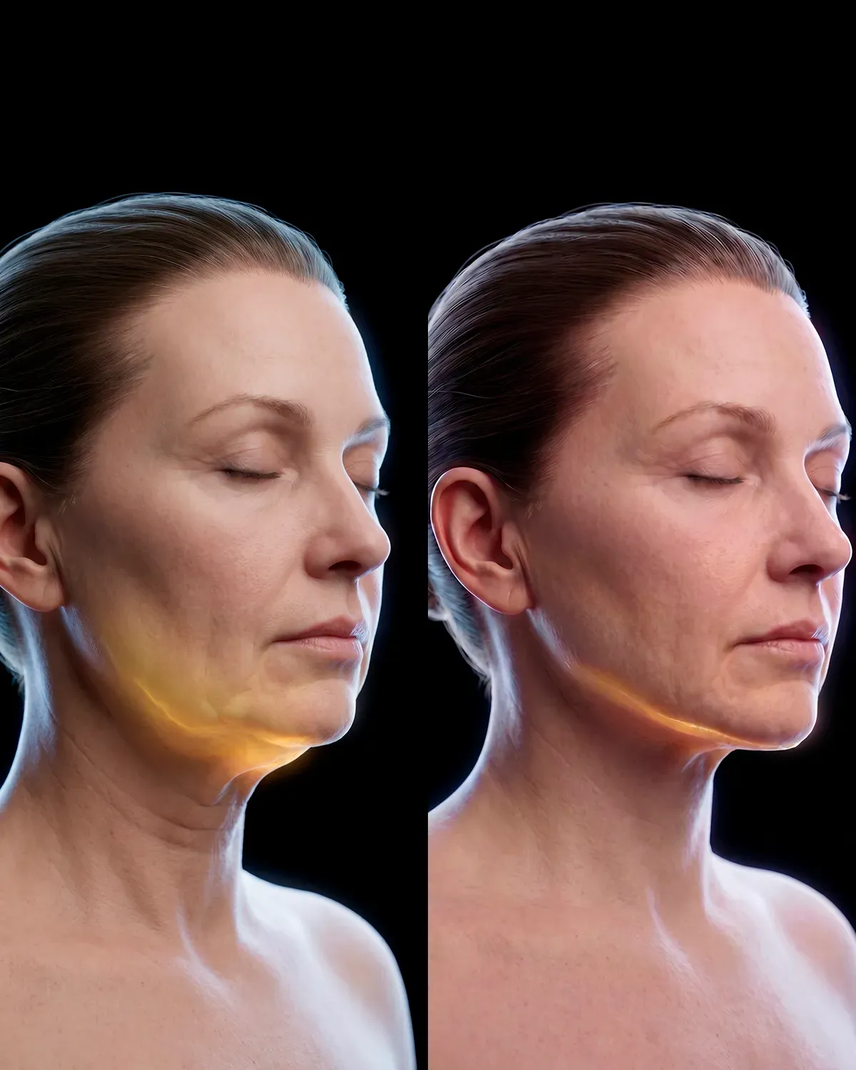 Neck Lift e Lipo de Papada